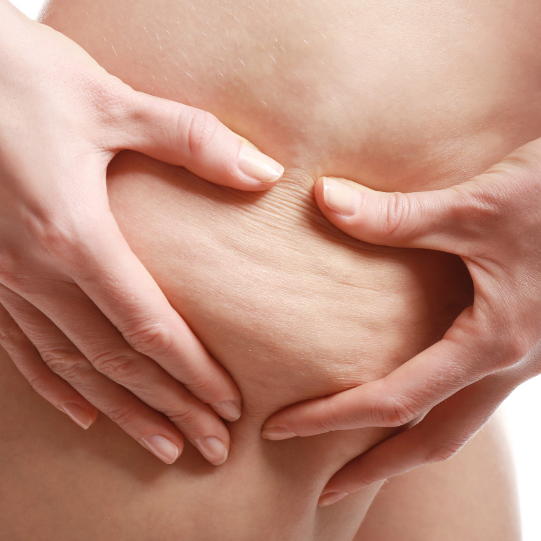 Grado 1 de Celulitis