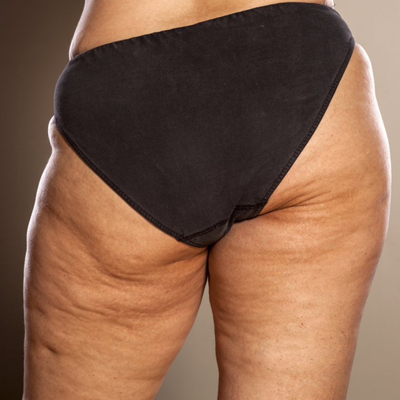 Grado 3 de Celulitis