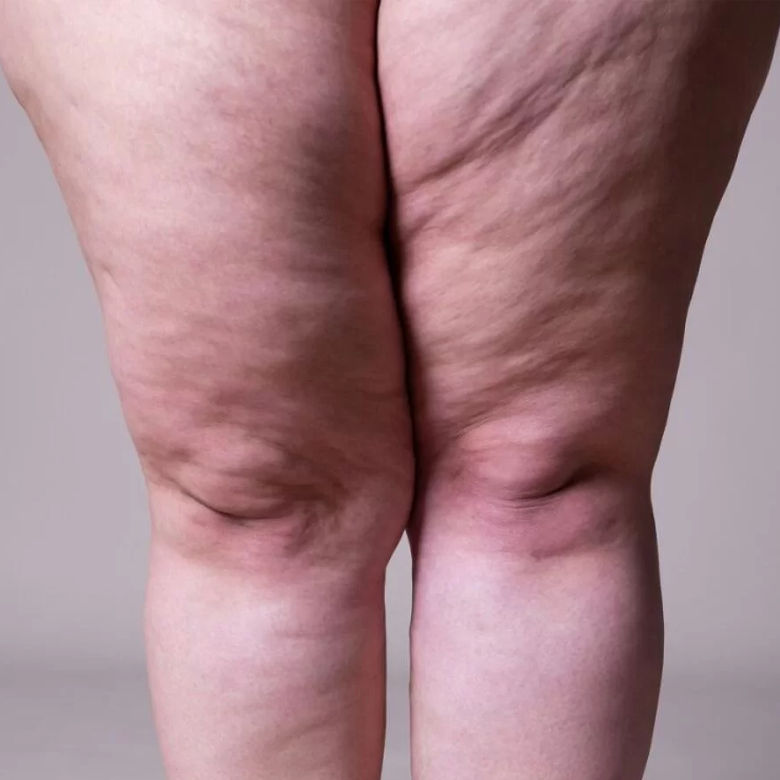 Grado 4 de Celulitis